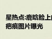 星热点:鹿晗脸上的疤是怎么回事?鹿晗脸上的疤痕图片曝光